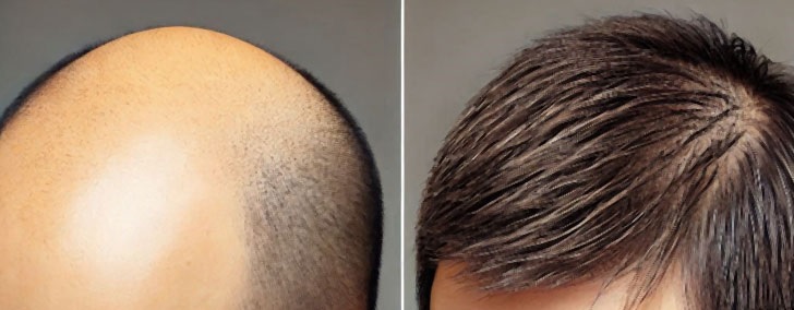 当サイト管理人の育毛ビフォーアフター