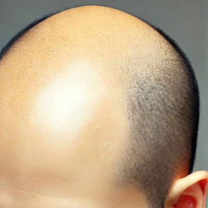 つるっぱげ完成